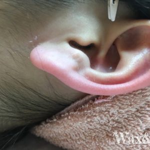 耳たぶワックス脱毛