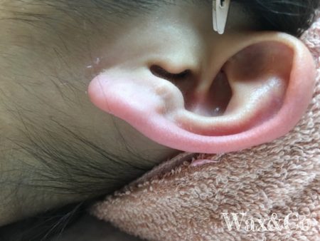 耳たぶワックス脱毛