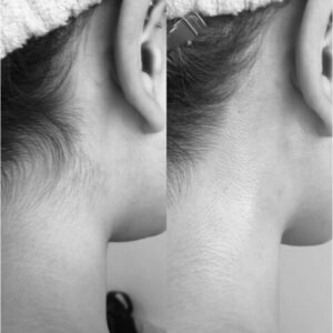 うなじワックス脱毛